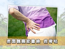 表面髖關節置換 救骨枯