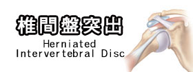 椎間盤突出[Herniated Intervertebral Disc]