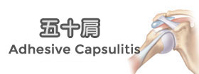 五十肩 - Adhesive Capsulitis