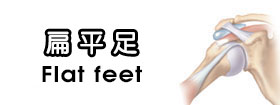 扁平足 - Flat feet