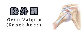膝外翻 - Knock-knee