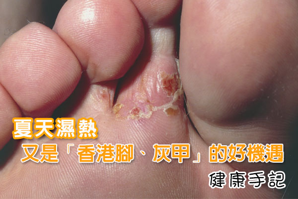 夏天濕熱、又是「香港腳、灰甲」的好機遇